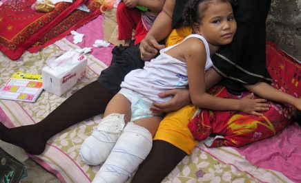7-year-old Samia, who was injured in a bomb attack in Yemen.