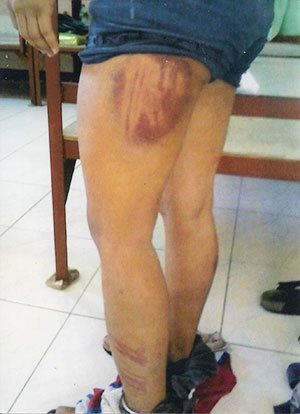 Alfreda Disbarro's bruises after being tortured by police in the Philippines